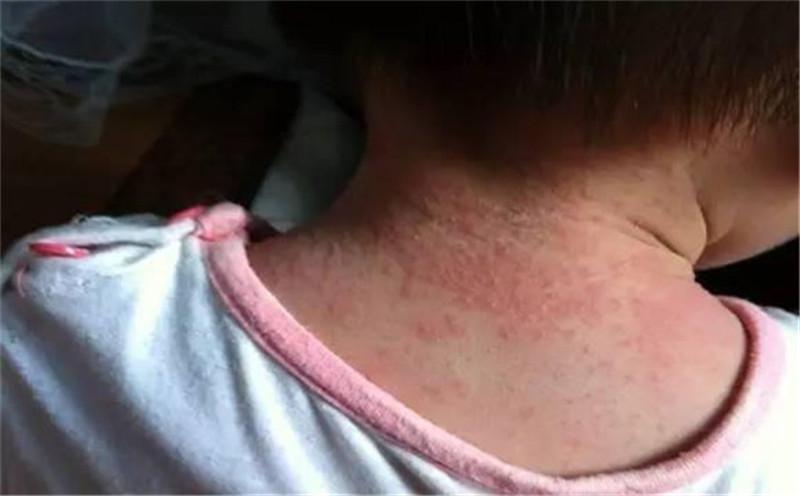 宝宝痱子治疗最好最快最有效,有什么东西能把宝宝痱子快速去掉