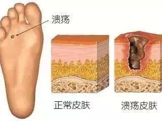 新鞋磨脚脚踝贴用法,新鞋磨脚贴