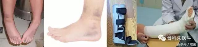 脚踝关节扭伤无骨折怎么恢复快,踝关节扭伤康复治疗注意事项