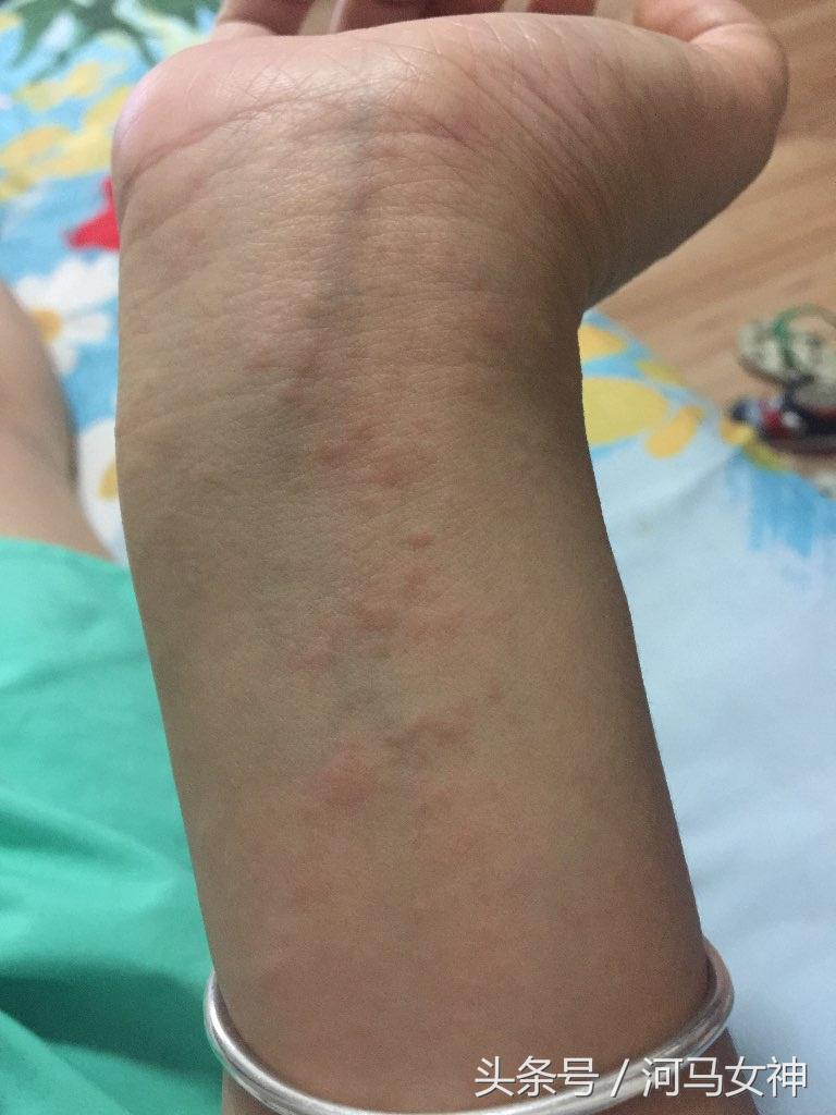 严重过敏反应首选的药物,对药物过敏反应