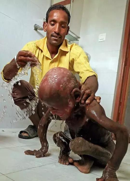 印度男孩身上长满了什么,印度11岁男孩长满鳞片