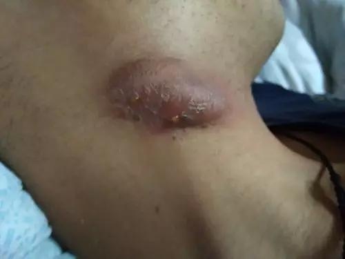 淋巴结肿大是甲状腺结节引起的吗,淋巴结肿大是瘰疬吗