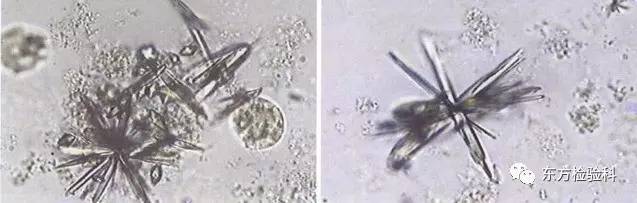 尿中结晶达到多少就是结石了,尿结晶数高是病吗