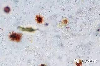 孕妇尿结晶数值多少是结石,尿结晶数量高看什么科