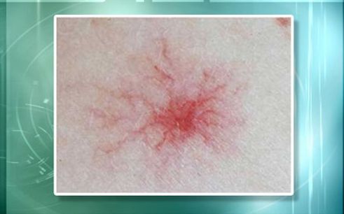 有像痣一样的小红点不痛不痒,身上长小红点像小白点