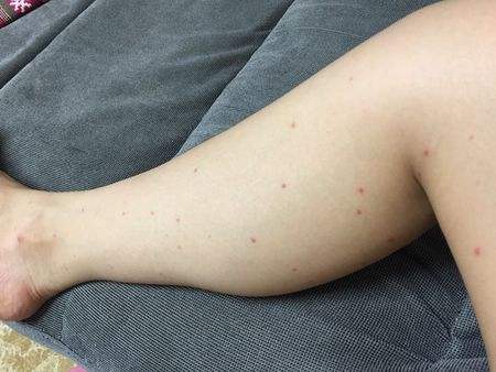 手臂上长了小红点不痛不痒像痣,出现小红痣不痛不痒