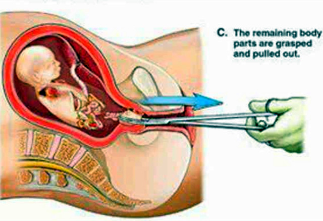 怀孕四个月又是女儿做引产，引产对胎儿到底有多残忍！