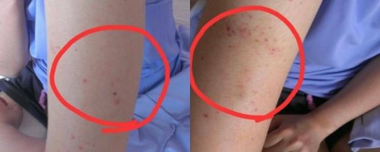 手臂上长了小红点不痛不痒像痣,出现小红痣不痛不痒
