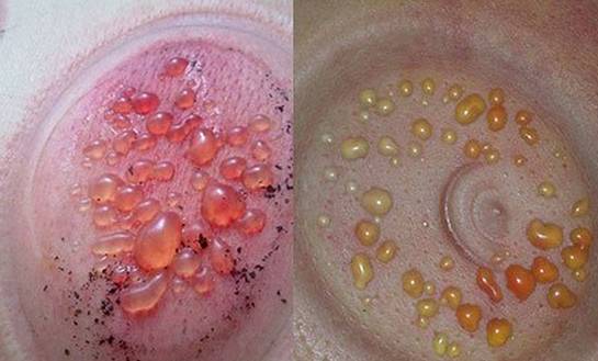 拔罐后不同位置罐印颜色不同,拔罐出现罐斑的原理