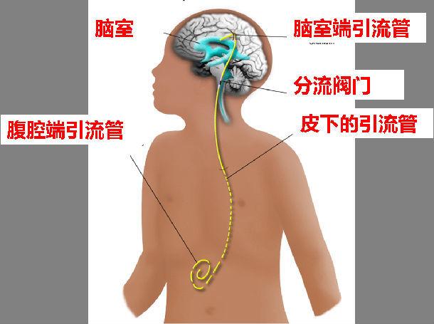 脑积水分流术后的常见并发症及处理措施