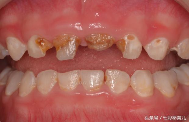 婴儿也会蛀牙！妈咪必学的幼儿牙齿保健术