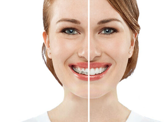 成人可以牙齿矫正,成人矫正牙齿的利与弊