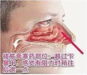 鼻炎鼻窦炎最佳的治疗方法,鼻炎鼻窦炎如何有效治疗