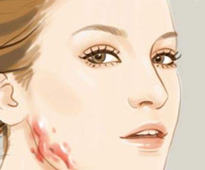 颈部淋巴结手术疤痕可以消除吗,颈部疤痕如何去除