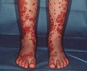 过敏性紫癜的正确治疗方法是什么,中医治疗过敏性紫癜的机理