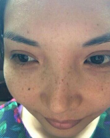 妈妈为女儿消脸上疤,妈妈为了孩子不容易