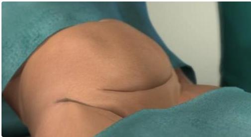 给孩子看的剖腹产手术全部流程,剖腹产手术最详细的介绍