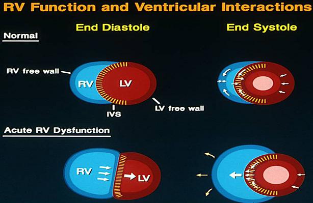 右室心肌梗死怎么回事,右心梗致右心衰