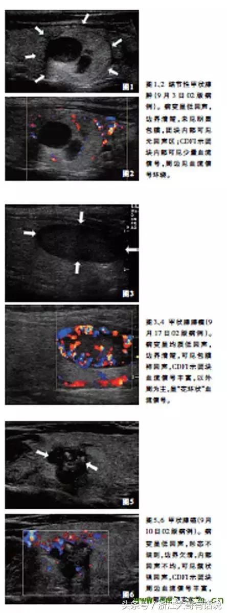 桥本氏甲状腺炎甲状腺超声表现,发现甲状腺结节如何诊断和治疗