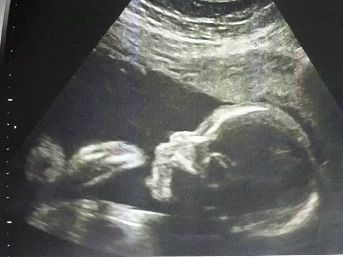 胎儿b超字母代表啥,胎儿b超单上的英文缩写