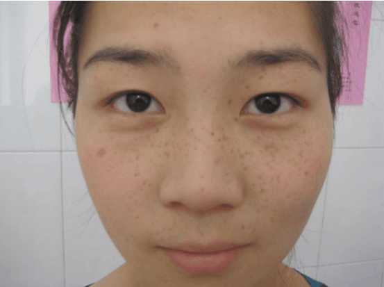 怀孕以后痘痘没有了皮肤变好了,怀孕初期满脸疙瘩怎么回事