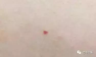 身上出的小红痣是什么原因造成的,身上出现小红痣是什么病症状