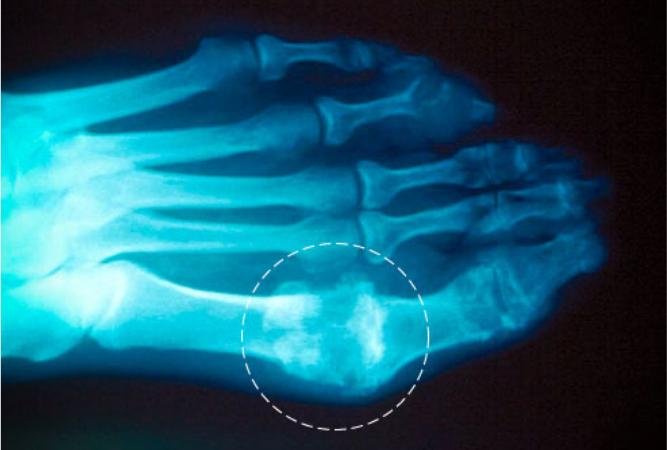 痛风常见的100个常识,痛风症治疗及预防方法