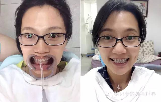 她们说||那些年整牙吞下的血和泪,终于换来最开怀的大笑