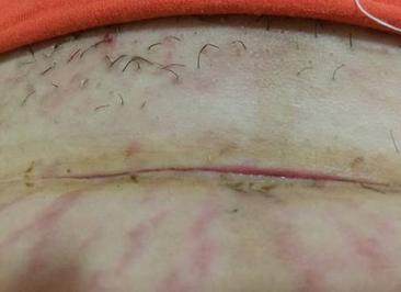 孕妇把剖腹产的伤口裂开了怎么办,孕妇剖腹产伤口裂开会怎样