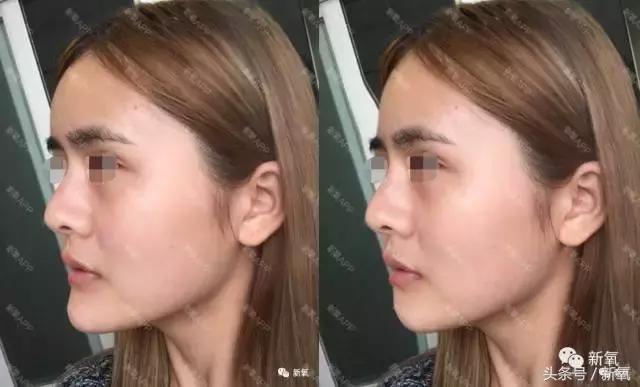 杨紫微整前后容颜对比,杨紫瘦了吗