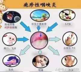 小儿疱疹性咽峡炎用什么中药贴敷,儿科孙丽萍