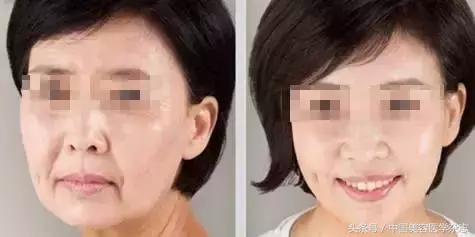 线雕面部提升女的,少女线雕术