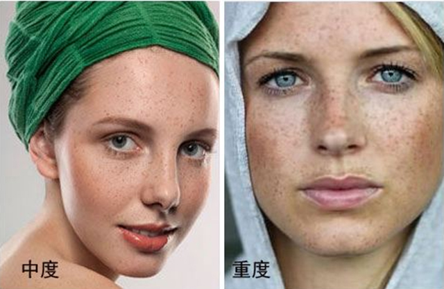 褐青色斑怎么预防,褐青色斑如何预防