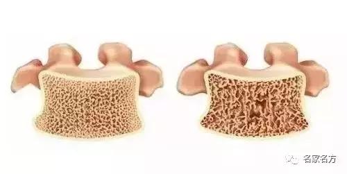 你的骨头正在泡沫化！知名康复专家：一颗洋葱就能帮你找回骨本