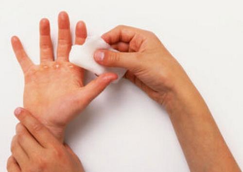 滚烫开水烫伤现场如何急救,手背被开水烫伤了怎么急救