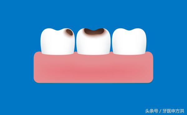 牙齿从有蛀牙到完全坏要多长时间,蛀牙从牙釉质到牙髓一般需要多久