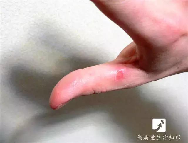 大人被开水烫伤怎么处理好得快,开水烫伤急救知识