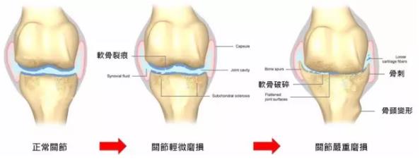 骨关节炎：排在首位的致残性疾病！（附靠谱的三甲医院和医生名单）