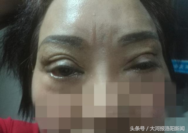 协和医院双眼皮手术哪个大夫好,协和医院黄久佐双眼皮修复案例