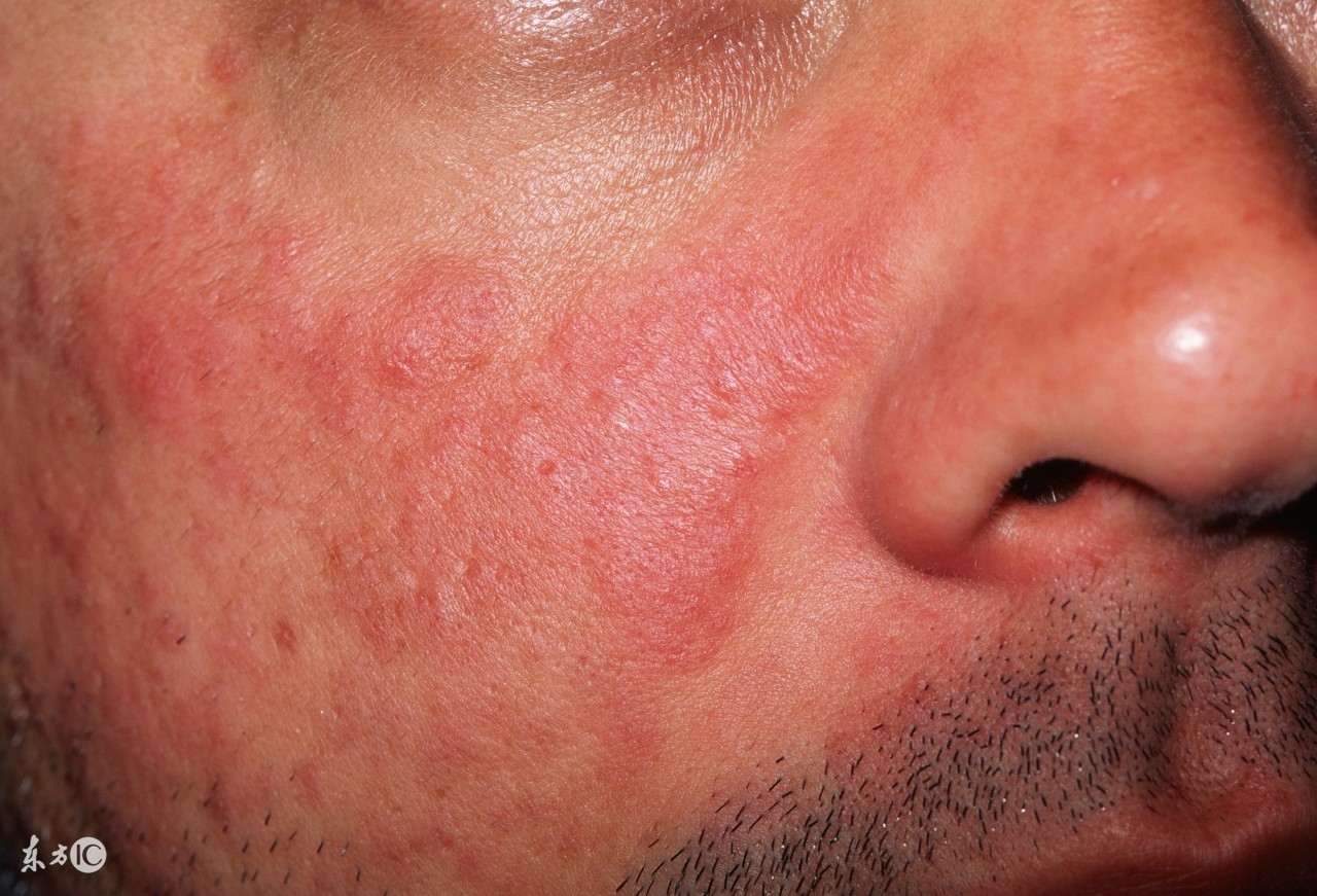 红斑狼疮记忆差怎么改善记忆,红斑狼疮如何消除皮疹