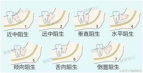 智齿长歪能不能矫正,智齿长歪了疼需要用什么牙膏