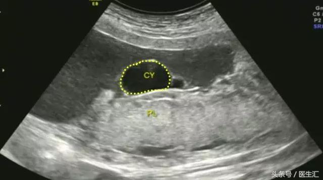 胎盘早剥病例课件,胎盘早剥的超声鉴别诊断