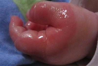 滚烫开水烫伤现场如何急救,手背被开水烫伤了怎么急救