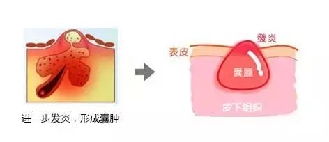 痘痘闭口一直不好,痘痘摸起来硬硬的很疼反反复复