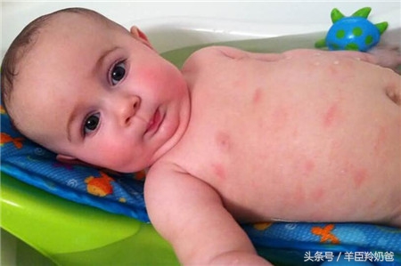 以前对猕猴桃不过敏现在却过敏,吃火龙果过敏吃猕猴桃会过敏吗