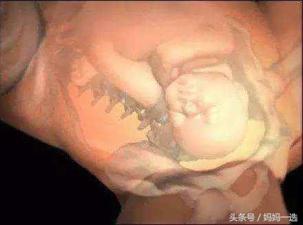 顺产就像断了18根肋骨,顺产真的是20根肋骨同时断裂吗