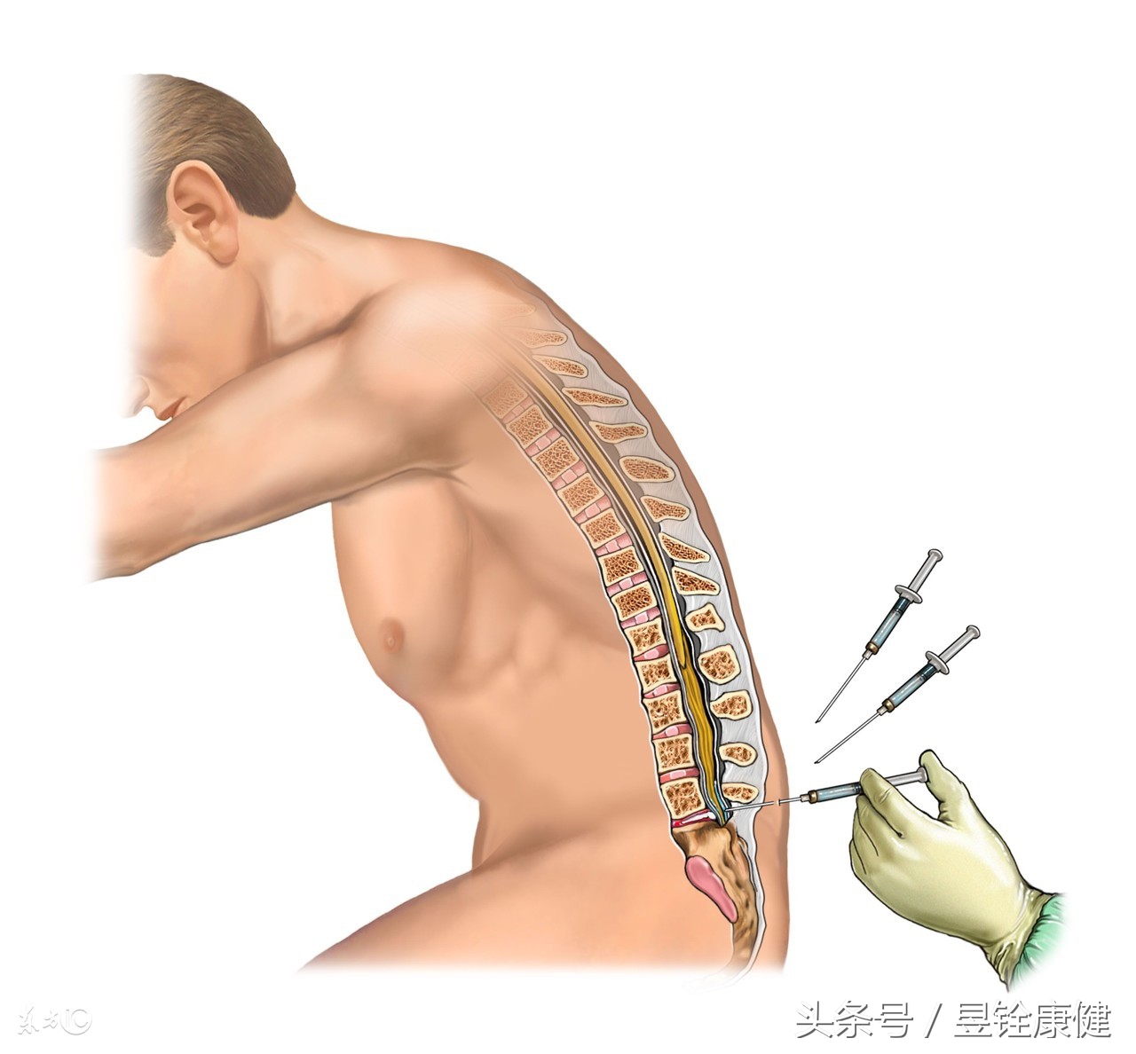 腰椎间盘突出症完全康复不是梦！早诊断、早治疗！