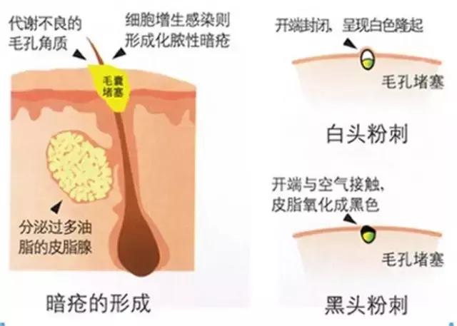 痘痘闭口一直不好,痘痘摸起来硬硬的很疼反反复复
