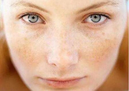 鼻梁色素沉着黑斑怎么祛除,眼镜压过鼻梁黑色素沉积