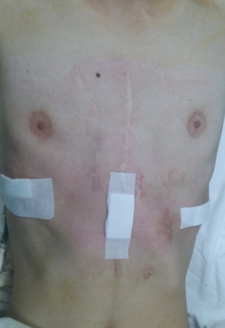 鸡胸手术恢复过程痛苦吗,鸡胸22岁手术还有效果吗